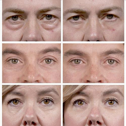 Thin Lizzy - Puffy Eye Remover Microcream - Before and After